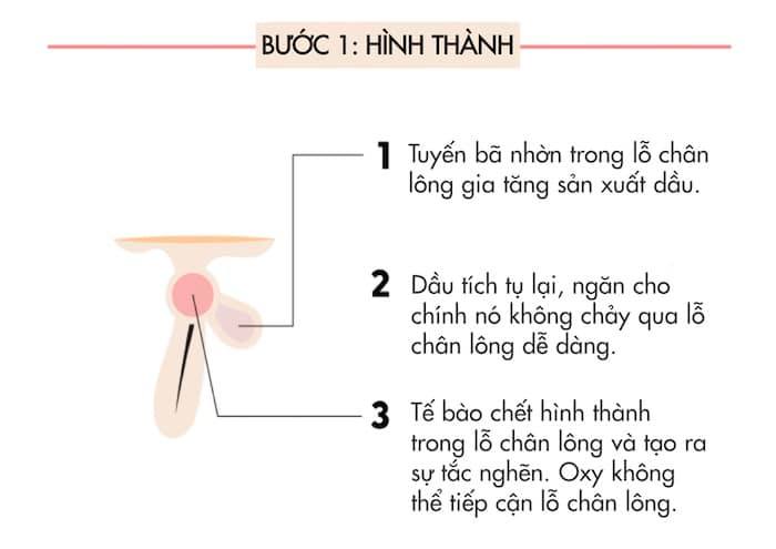 Tâm tình về mụn